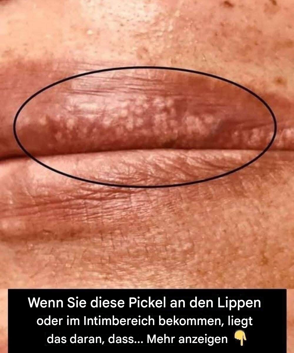 Wenn Sie diese Pickel an den Lippen oder im Intimbereich bekommen, liegt das daran, dass…