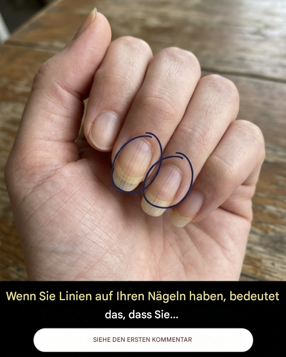 Wenn Sie Rillen auf Ihren Nägeln haben, bedeutet das, dass Sie… Mehr anzeigen
