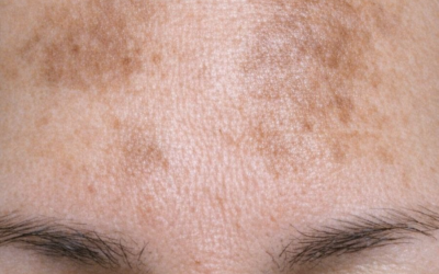 Tragen Sie diese Mischung auf Ihre Stirn auf und beseitigen Sie Melasma-Flecken, dunkle Flecken und ungleichmäßige Pigmentierung.