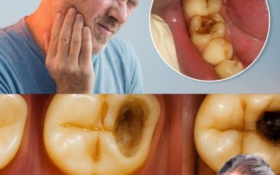 Haben Sie genug von Karies? Probieren Sie diese natürlichen Tipps für stärkere, gesündere Zähne.