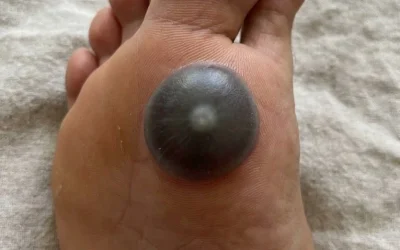 Meine Tochter ist mit einem großen Fleck am Fuß aufgewacht. Ich weiß nicht, was es ist. Es schmerzt und sie kann ihren Fuß nicht bewegen. Was ist das? Können Sie es mir erklären?