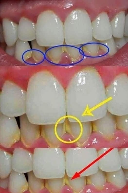 Zahnbelag natürlich entfernen: Einfache Tipps für eine bessere Mundhygiene