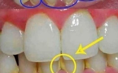 Zahnbelag natürlich entfernen: Einfache Tipps für eine bessere Mundhygiene