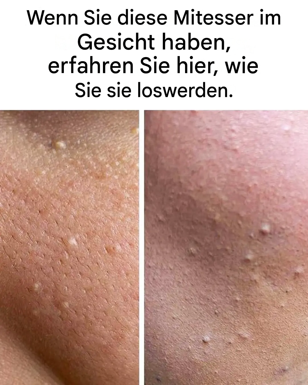 Diese kleinen weißen Pickelchen auf der Haut: Ursachen und Lösungen, um sie loszuwerden