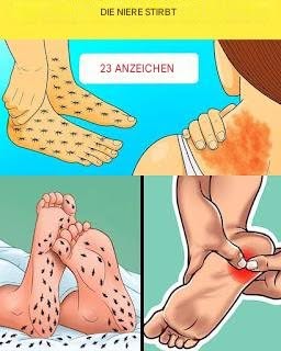 23 Warnzeichen, dass Ihre Nieren möglicherweise Hilfe benötigen
