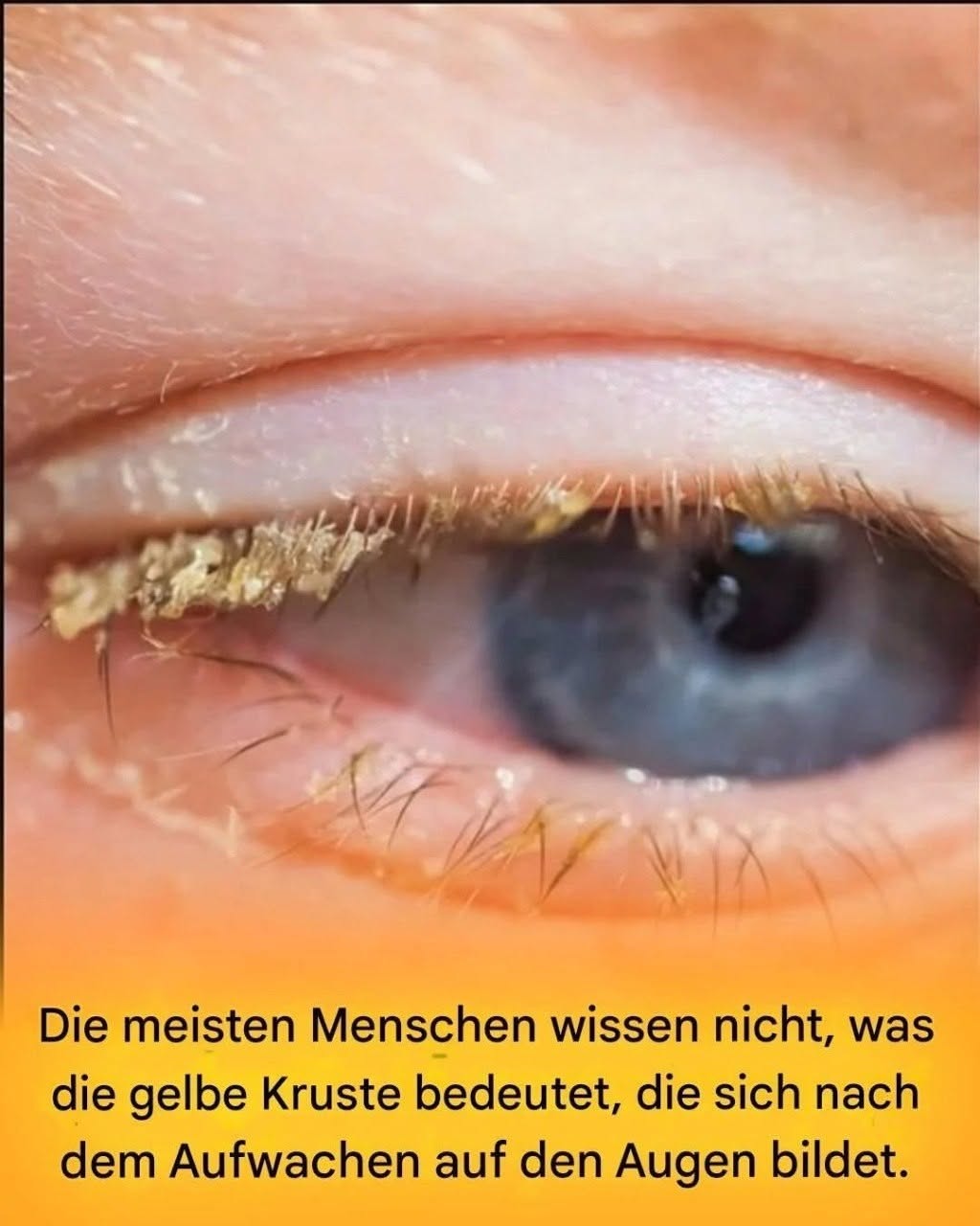 Gelbe Kruste beim Aufwachen: Was bedeutet das?