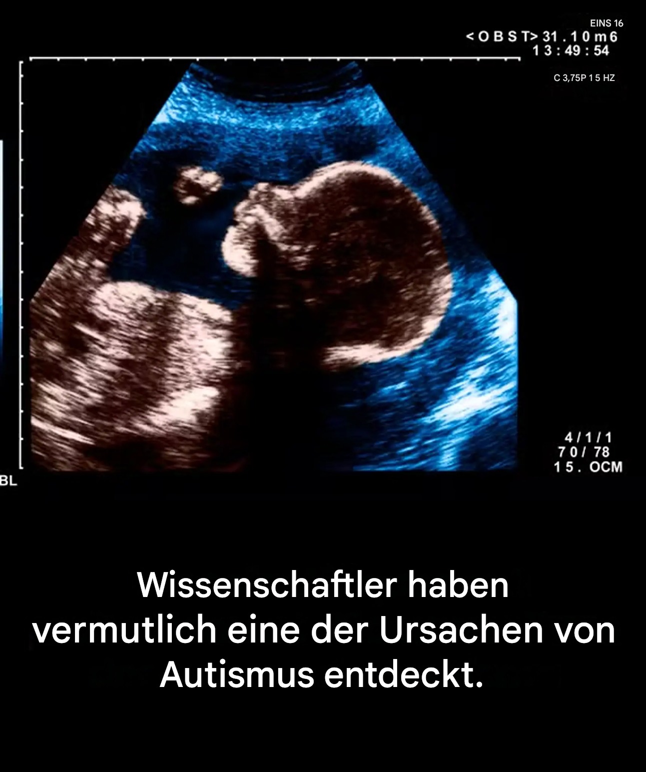 Wissenschaftler haben möglicherweise eine der Ursachen von Autismus entdeckt.