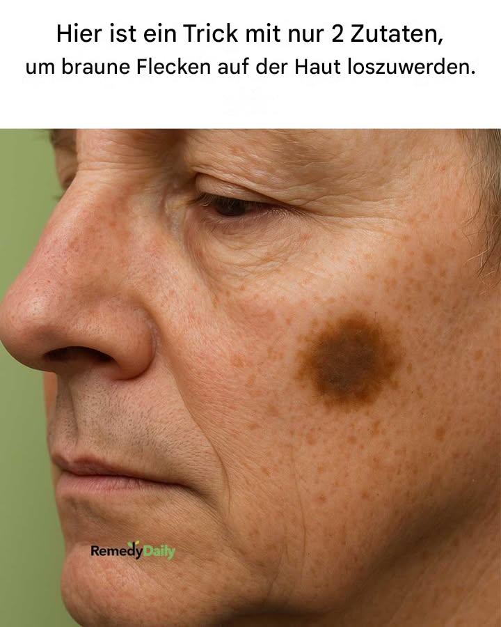 Hier ist ein Hack mit zwei Inhaltsstoffen, um braune Flecken auf deiner Haut loszuwerden