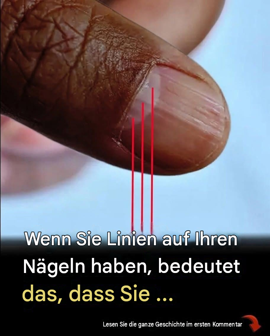 Linien auf den Nägeln können auf Nährstoffmängel oder andere gesundheitliche Probleme hinweisen.