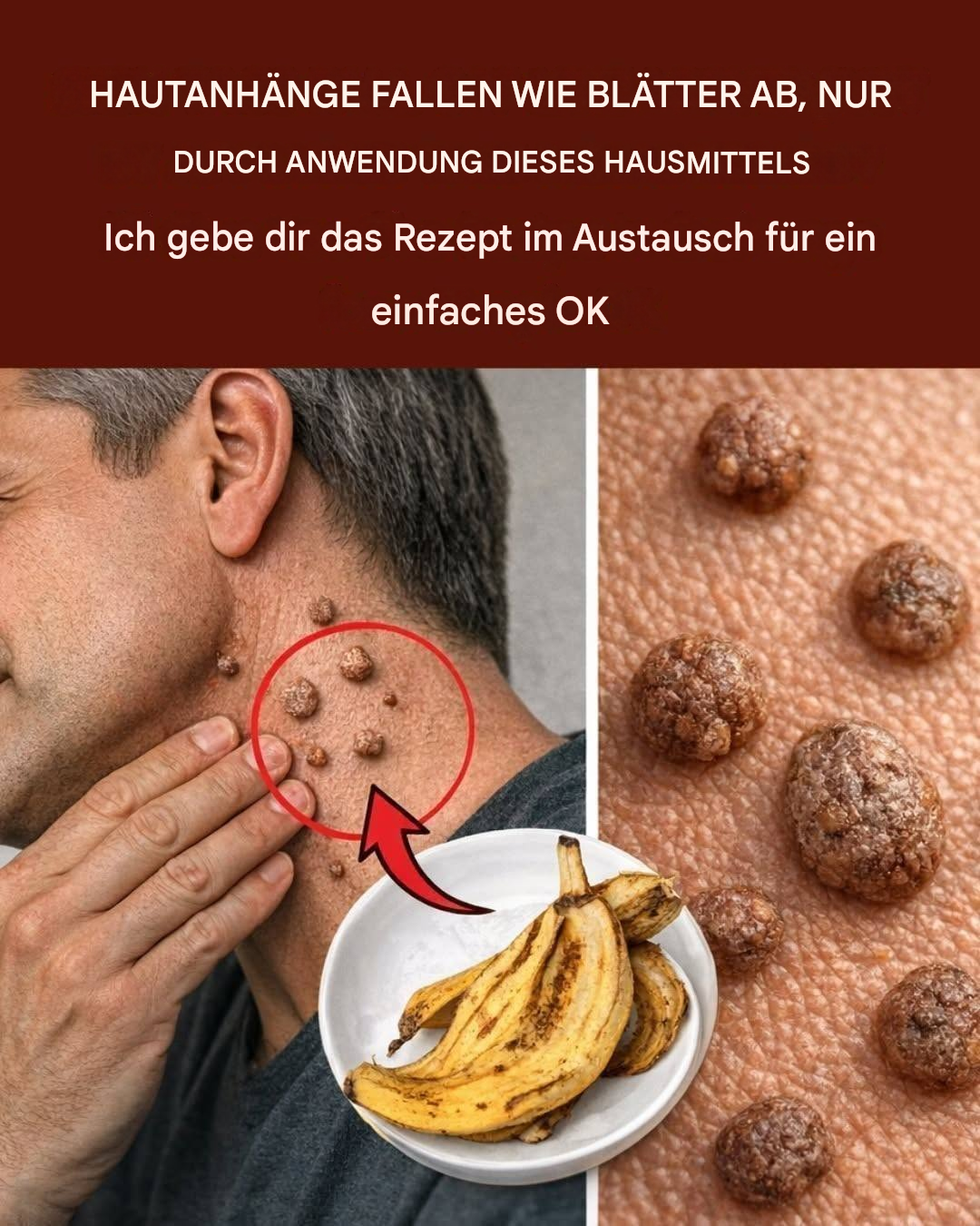 Die Warzen fallen wie Blätter ab, wenn man dieses Hausmittel anwendet. Ich gebe Ihnen das Rezept im Austausch für nur ein Wort: 1