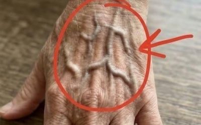 Wenn Ihre Venen sichtbar sind, bedeutet das Folgendes… Mehr anzeigen