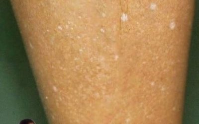 Weiße Flecken auf der Haut: Welche Vitaminmängel könnten die Ursache sein